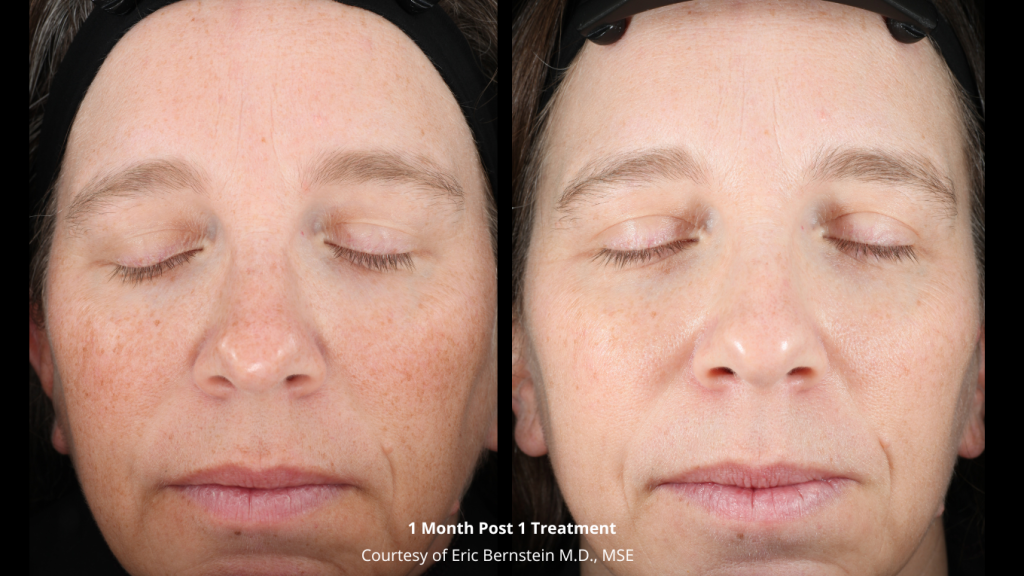 Before-and-After_-Bernstein-1