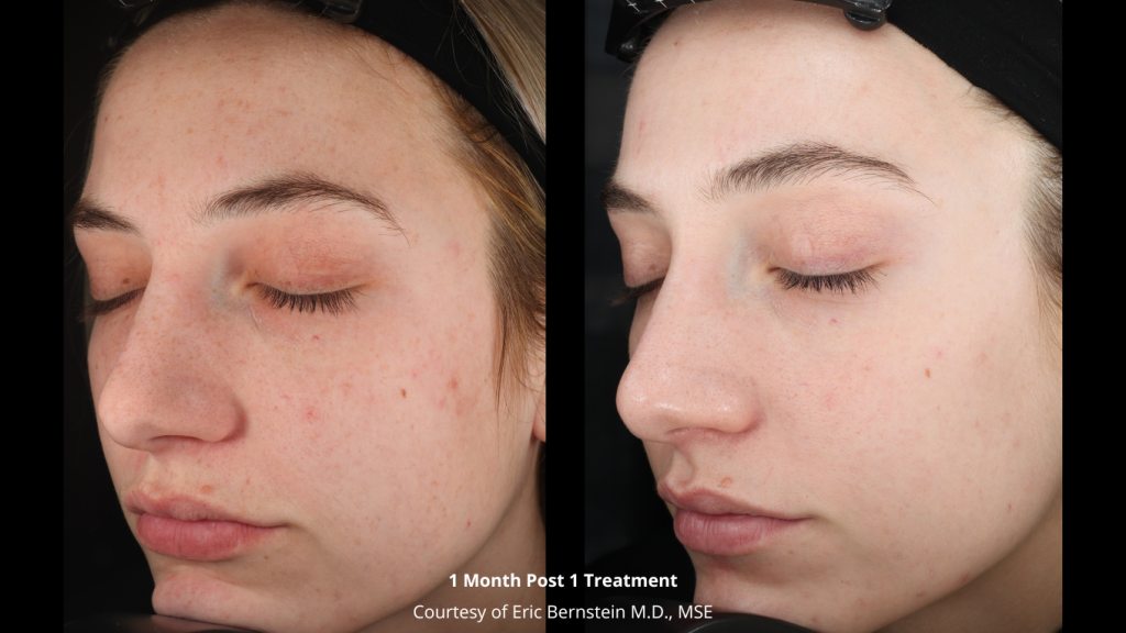 Before-and-After_-Bernstein-2